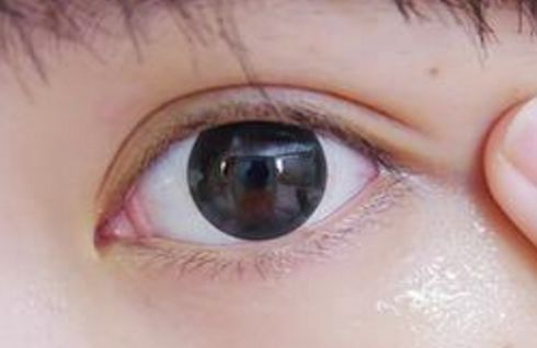 山東割眼袋哪家醫(yī)院好？眼袋手術(shù)山東醫(yī)院哪家專業(yè)靠譜？