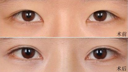 大連假體隆鼻哪家醫(yī)院好？打造完美鼻型，這家醫(yī)院是最佳選擇！