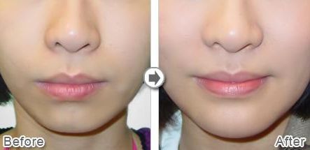 武漢熱瑪吉技術(shù)治療最好的醫(yī)院是哪家？