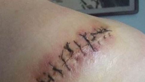 信陽(yáng)哪家醫(yī)院祛痘效果好，專家推薦去哪家醫(yī)院治療痘痘？