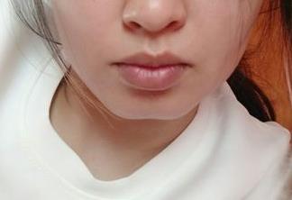 2023溫州疤痕微創(chuàng)手術(shù)正規(guī)專家前10位(蔡東亮、張波、王津評價看是網(wǎng)紅收費也不坑人)