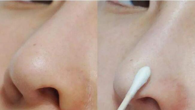 重慶華美整形美容醫(yī)院韋志遠疤痕修復(fù)效果體驗分享