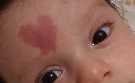 肖開宇修復(fù)雙眼皮的方法淺析，成都知名整形醫(yī)生成功案例分享！