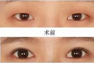 昆明哪家醫(yī)院做熱瑪吉好？挑選昆明熱瑪吉治療專業(yè)的醫(yī)院指南