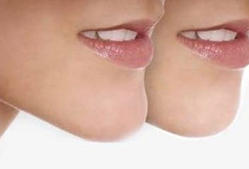 河南唇腭裂休復哪家好？專業(yè)醫(yī)院推薦及成功案例分享