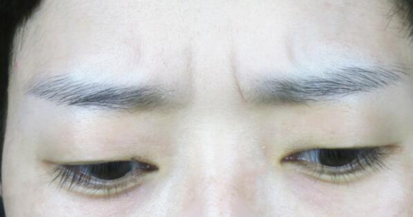 林沸騰整形醫(yī)院福州隆胸手術(shù)效果評價(jià)