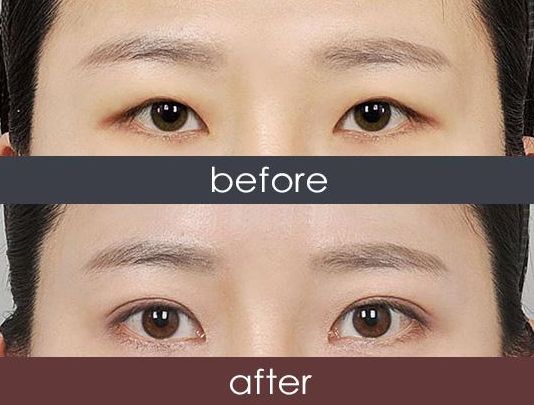 福州哪家醫(yī)院激光祛雀斑效果好？