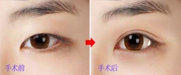 上海玻尿酸豐唇哪家醫(yī)院好？挑選上海口碑好的玻尿酸豐唇醫(yī)院