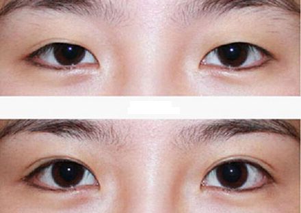 【2023年蘭州歪脖子手術(shù)哪家好？專家推薦+真實(shí)案例分析】