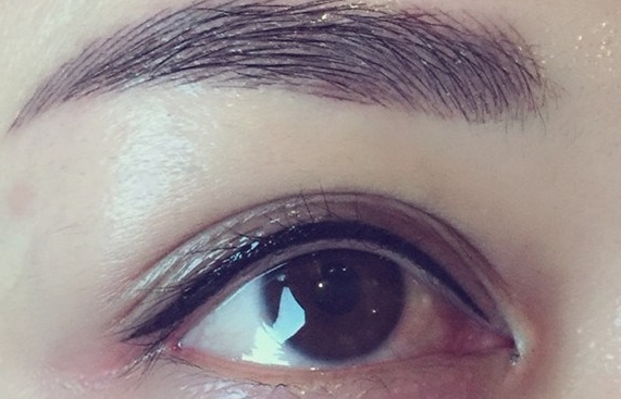 泉州碧蓮盛植發(fā)效果如何？亞雄醫(yī)生詳解脫發(fā)煩惱+無痕種植經(jīng)驗分享