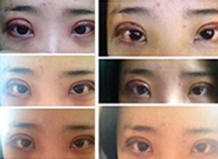 長沙哪家醫(yī)院的拉皮手術(shù)最好？專家推薦的拉皮手術(shù)醫(yī)院有哪些？