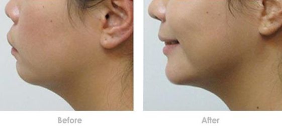 成都哪家醫(yī)美醫(yī)院做皮秒好？了解成都皮秒治療哪家醫(yī)院口碑好