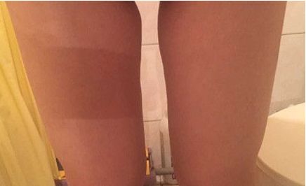 山東哪家醫(yī)院治療疤痕好？挑選最適合您的醫(yī)療機構！