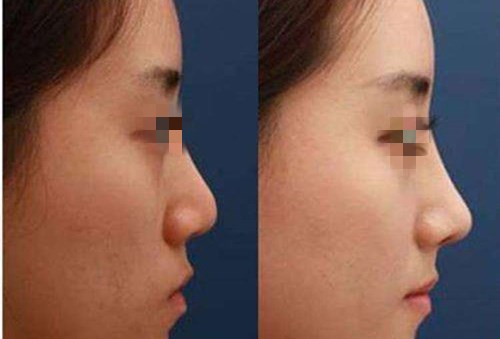 鄭大二附院：魏星vs劉月麗「誰更具魅力」雙眼皮對決揭曉！