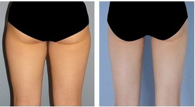 福州哪家醫(yī)院的臉部拉皮手術效果好