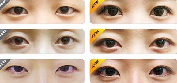 北京做雙眼皮哪家醫(yī)院好？排名最靠前的北京雙眼皮醫(yī)院有哪些？