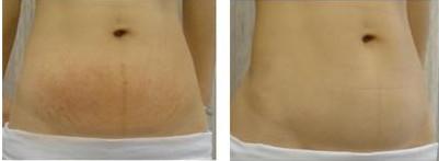 2023浙江專業(yè)無痕除皺術上榜清單前10位專家(潘蕾、孫燚、姚偉華口碑與實力雙重保障！)