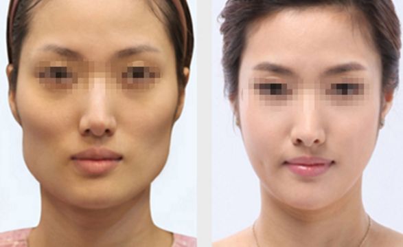 長春雙眼皮修復好的醫(yī)院有哪些？