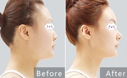 貴陽治療痘坑哪家醫(yī)院專業(yè)可靠？