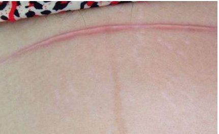 福州哪家醫(yī)院打玻尿酸效果好？