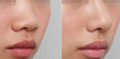 深圳修復(fù)雙眼皮哪家醫(yī)院好？淺談深圳雙眼皮修復(fù)專家排行榜