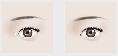 東莞哪家醫(yī)院開眼角好？專家推薦優(yōu)質(zhì)平價(jià)醫(yī)療機(jī)構(gòu)！