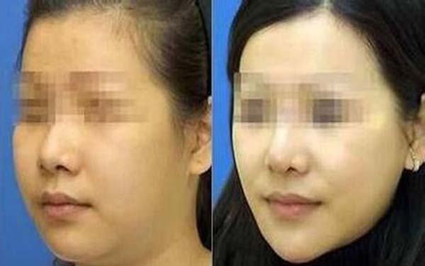 杭州華山整形醫(yī)院陳敬武隆鼻修復(fù)效果如何評價