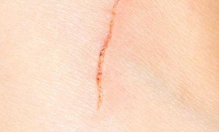 浙江開眼角哪家醫(yī)院技術(shù)好？選擇哪家醫(yī)院效果最佳