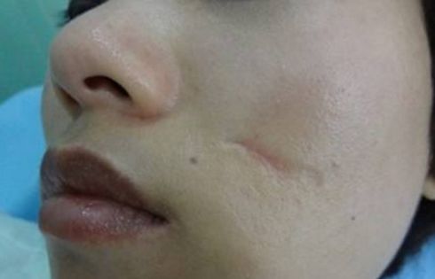 吉林市切開雙眼皮哪家好？一篇詳細(xì)的雙眼皮手術(shù)評(píng)測(cè)指南。