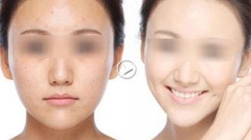 廣州哪家醫(yī)院去黑頭好？揭秘廣州專業(yè)祛黑頭效果最佳的醫(yī)療機(jī)構(gòu)