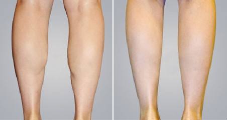 2023江門自體脂肪墊鼻基底口碑榜前十強的專家(周俊、黃銀嬌、楊嬌技術(shù)專業(yè)、價格便宜)