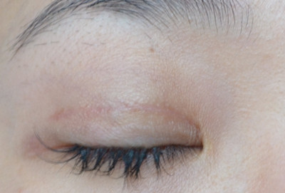 2023北京愛貝芙注射填充去痘疤醫(yī)生前10強(qiáng)排行(劉健、解永學(xué)、葉宇盤點(diǎn)實(shí)力派，特點(diǎn)對(duì)比！)