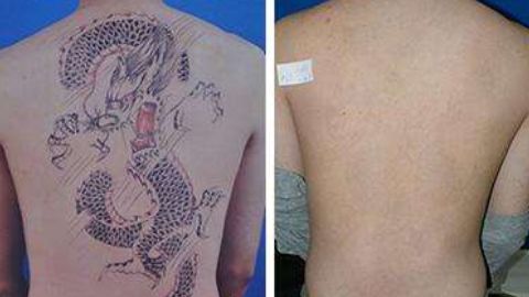 怎樣修復鄭荃疤痕，讓人滿意？