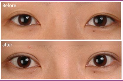 深圳墊鼻梁哪家醫(yī)院技術(shù)好且口碑可信？