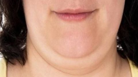 吳佳君醫(yī)生拉皮技術(shù)獨步一時，值得信賴嗎？費用如何計算？