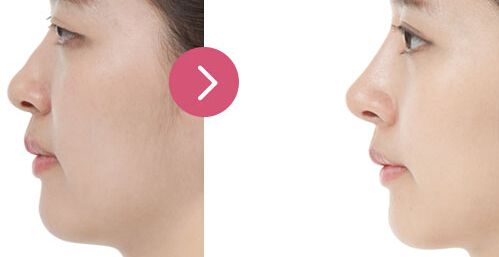 廣州哪家醫(yī)院眼部整形效果好，專業(yè)醫(yī)院推薦