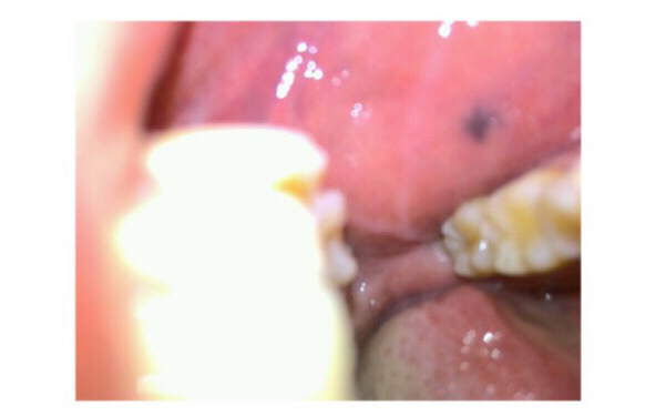 2023無錫切除木偶紋專家前10強(qiáng)榜(高飛、周祺林、王慧三位大咖特點(diǎn)分析！)