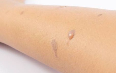 哈爾濱宋桂霞醫(yī)生為您解析雙眼皮手術(shù)的獨到體驗