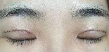 上海王會勇醫(yī)生鼻部整形案例分享：創(chuàng)新技術(shù)助您獲得完美鼻型！