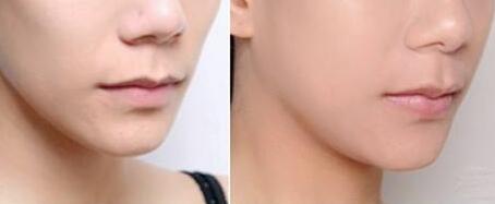 深圳徐斌的隆胸手術(shù)值得信任嗎？