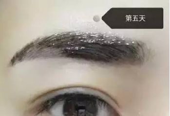 南昌美伊爾劉立軍醫(yī)生膨體隆鼻整形費(fèi)用？手術(shù)效果如何？帶您看醫(yī)生案例