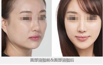 鄭州望京張鵬隆鼻2023年實(shí)力及成功案例公開(kāi)，讓您放心無(wú)憂