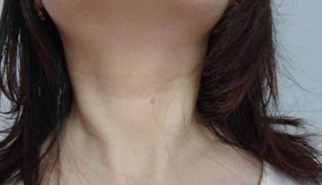 江華教授隆胸術(shù)，口碑與收費(fèi)詳解