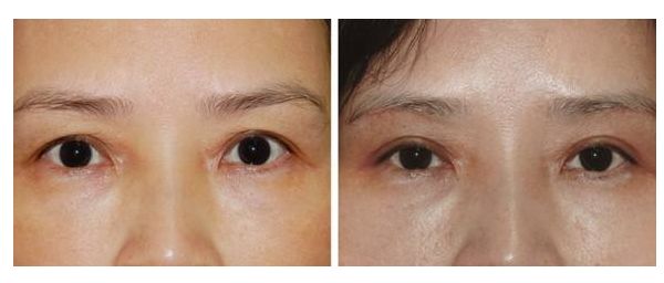 女生變成網(wǎng)紅臉需要多少投入？解析投資成本及效益