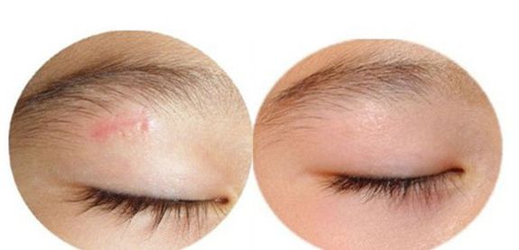 廣州曙光醫(yī)院雙眼皮手術(shù)手藝高超，名醫(yī)推薦！附真實(shí)案例！