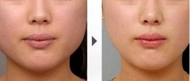 上海五位雙眼皮技術(shù)高超的專家匯總，排名唯一出爐