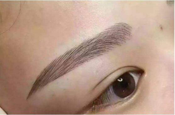 武漢葉子榮做拉皮的療效如何？專家醫(yī)生分享經(jīng)典案例