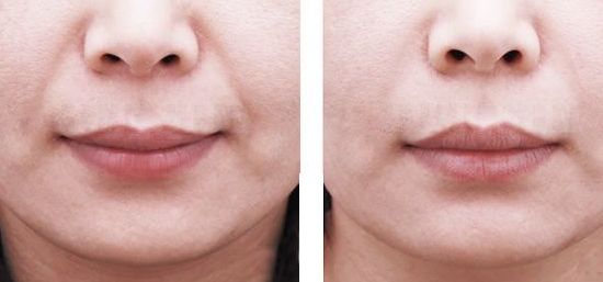 重慶藝星王永久醫(yī)生雙眼皮效果如何？90天招牌案例公開揭曉