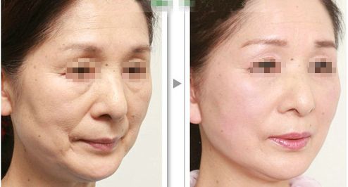 上海哪家磨骨醫(yī)院靠譜？華美、美聯(lián)臣、薇琳資歷雄厚值得信賴