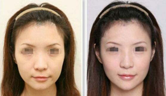 西安整形醫(yī)院吸脂減肥排行榜前五，用戶首選